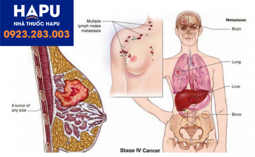 Ung thư gan có thể di căn tới nhiều cơ quan trên cơ thể